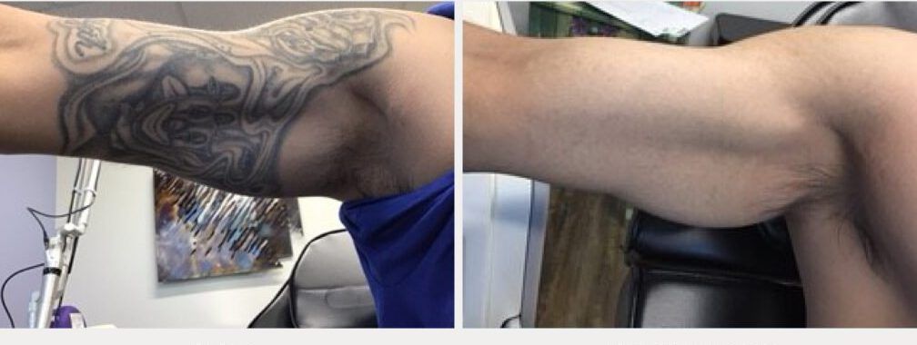 Upper arm tattoo before treatment and after 3 treatments