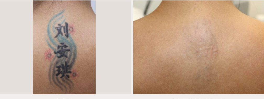 Back tattoo before treatment and after 13 treatments