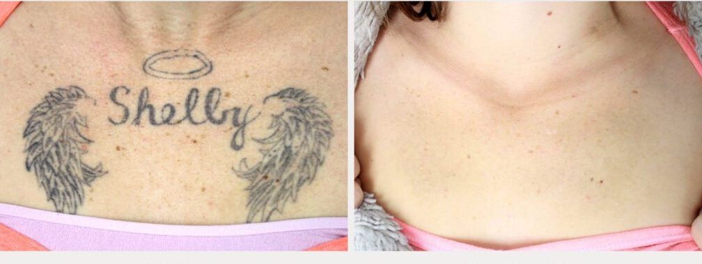 Chest tattoo before treatment and fully removed after 6 treatments