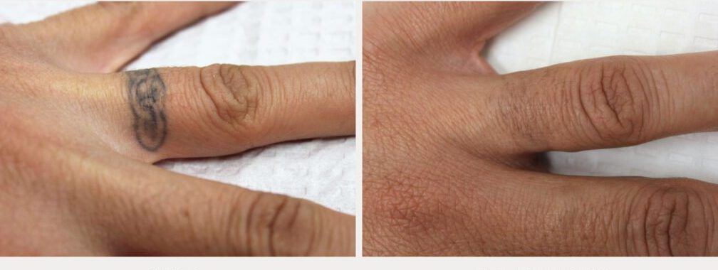 Finger tattoo before treatment and after 4 treatments