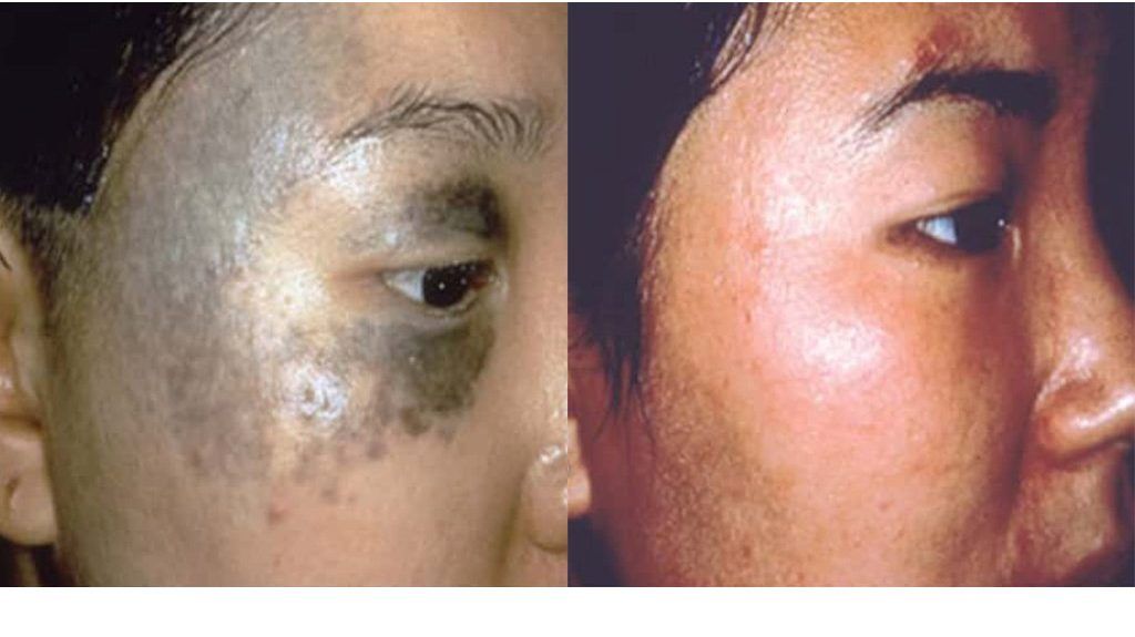 Facial pigmentation before and after PicoWay treatment