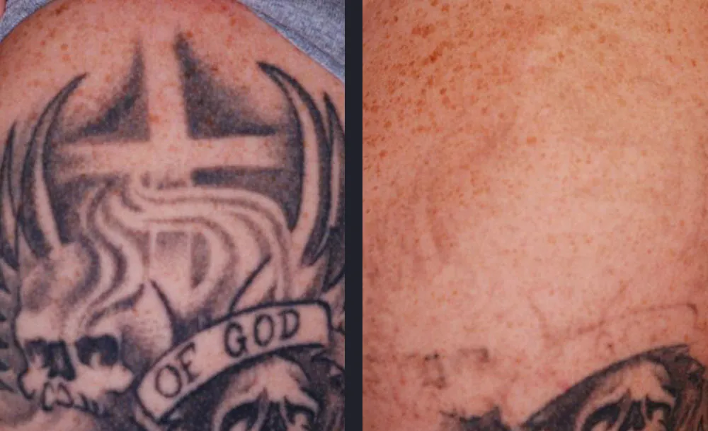 Shoulder tattoo before treatment and after 5 treatments