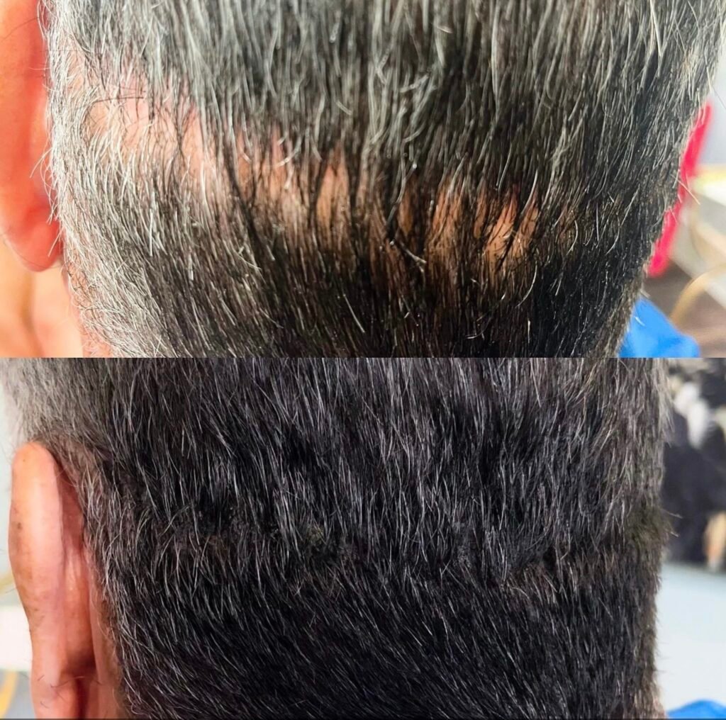Scalp micropigmentation before and after, thinning crown filled in